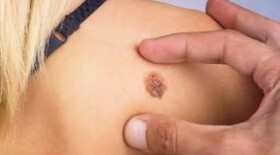 Пациентам помогут выявить злокачественные заболевания кожи по фотографии